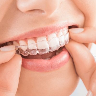 Invisalign clear aligners at The Tooth Stop
